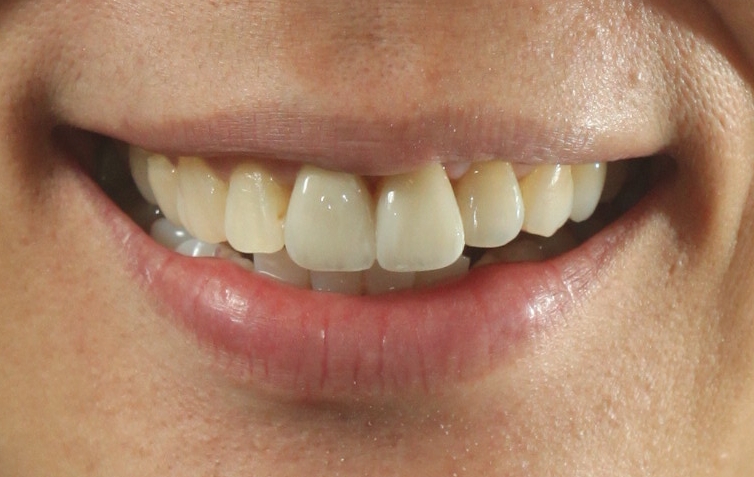 Catherine — Smile Makeover - After