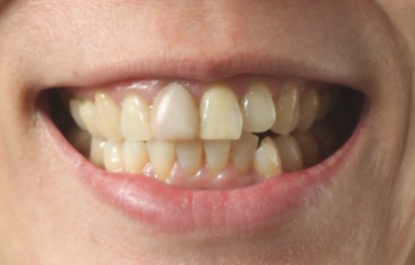Catherine — Smile Makeover - Before