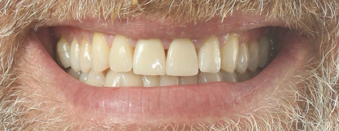 Daniel — Smile Makeover - After