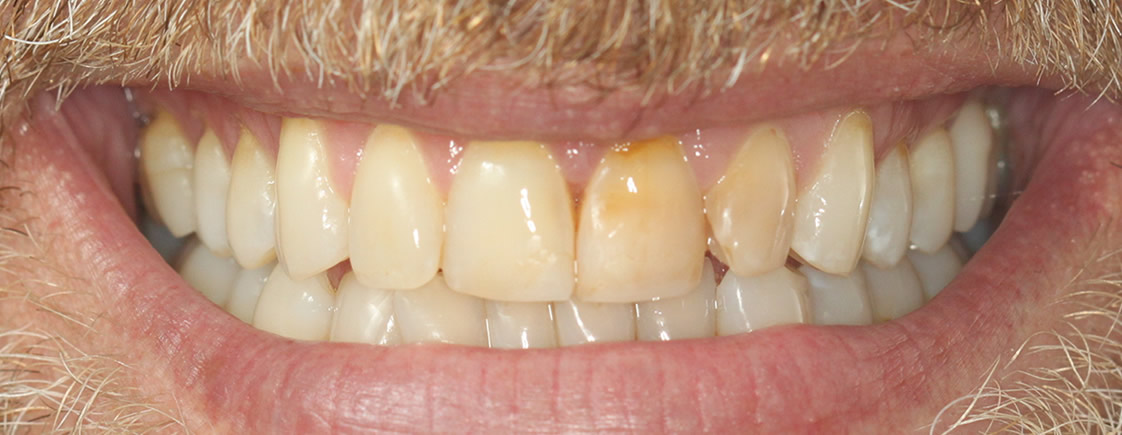 Daniel — Smile Makeover - Before