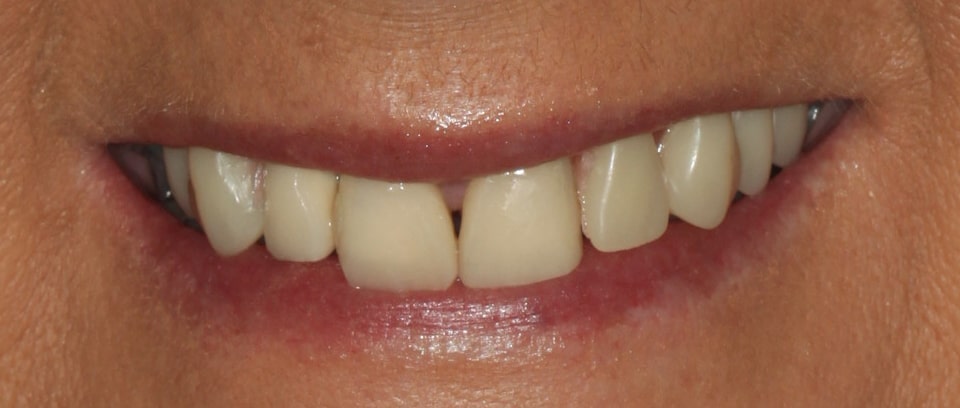 Jacquelin — Crowns & Denture - After