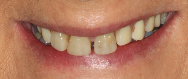 Jacquelin — Crowns & Denture - Before