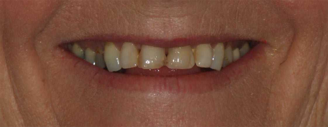 Karen — Smile Makeover - Before