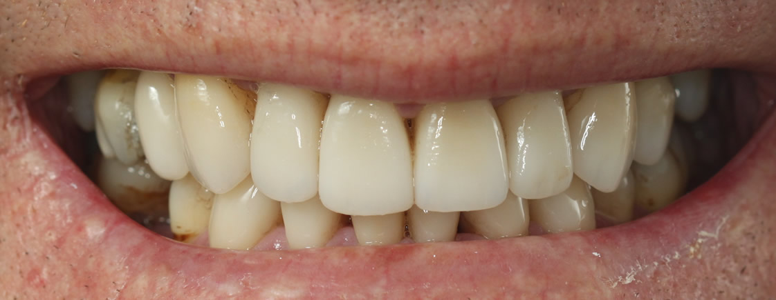 Rohan — Smile Makeover - After
