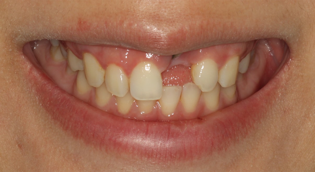 Valarie — Dental Implant - Before